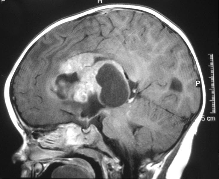 MRI image of a child's brain.