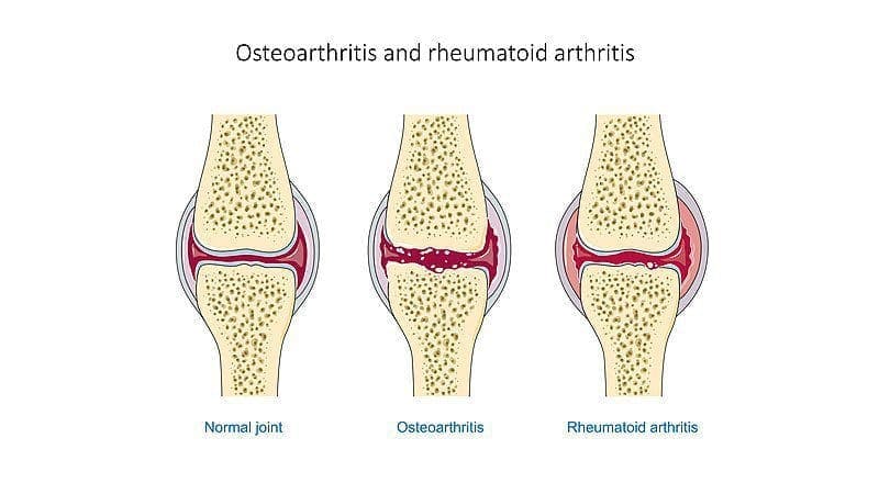 Drawing of a normal joint, one with osteoarthritis and one with rheumatoid arthritis.