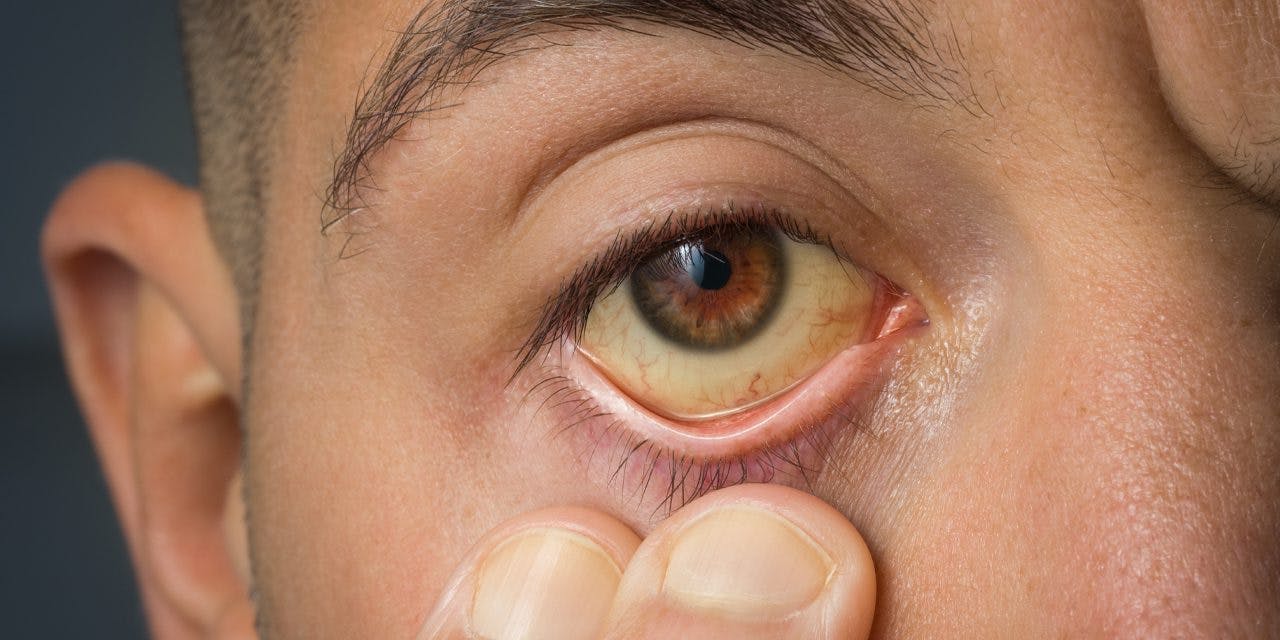 closeup man showing his yellowish eye
