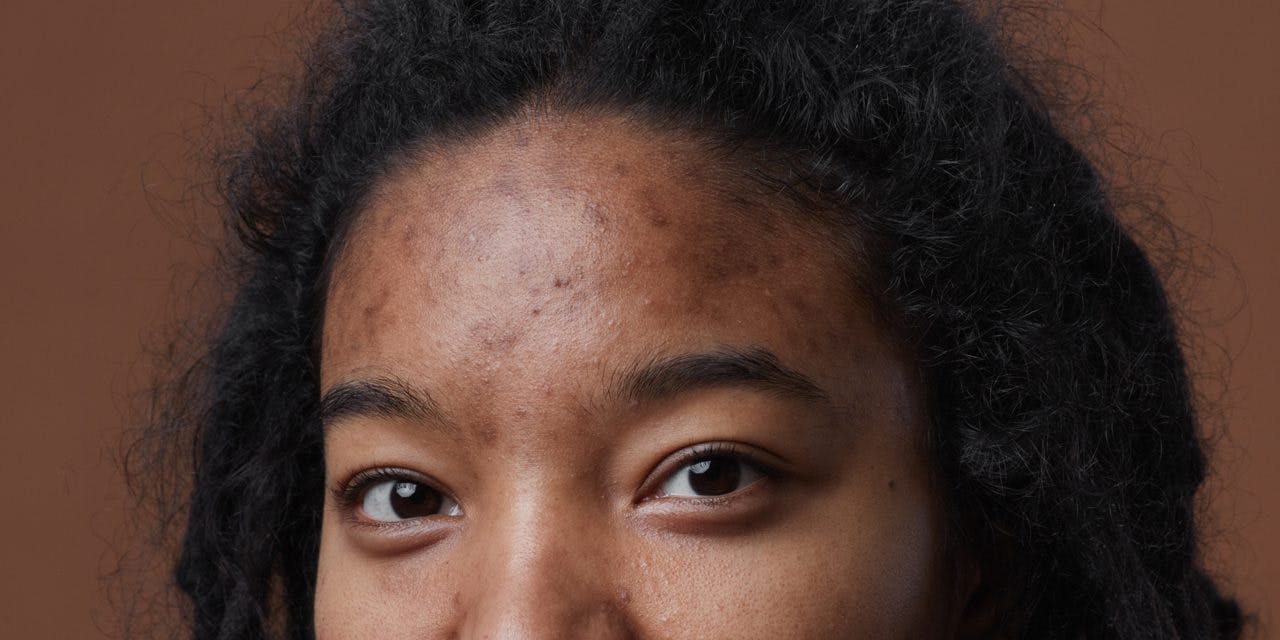 closeup half face portion of a woman showing her forehead with acne marks