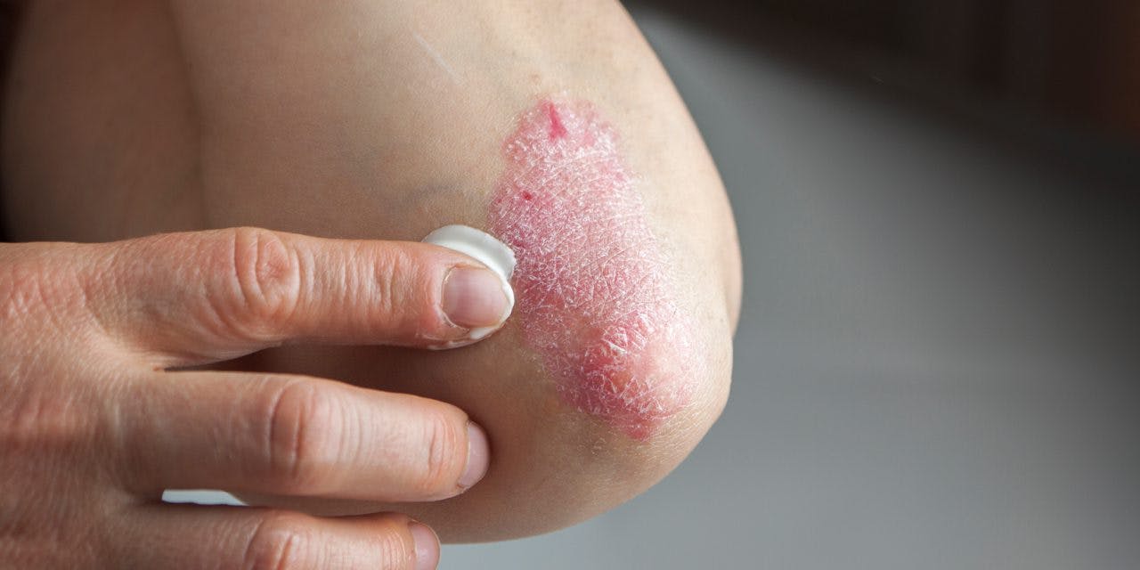 close-up of treatment of a psoriatic elbow with a psoriasis cream