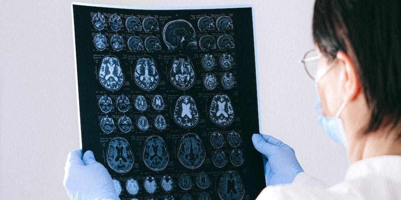 a doctor holding a brain scan result