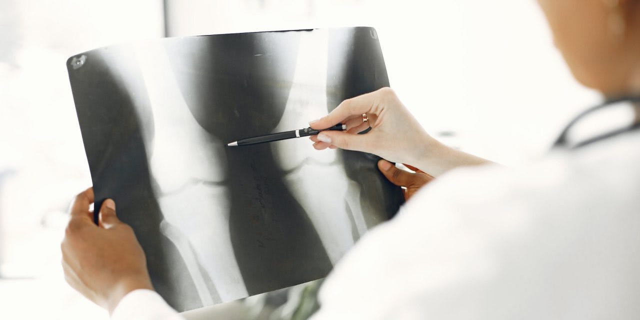 un médico que sostiene el resultado de una radiografía mientras apunta algo sobre el hueso